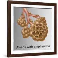 Alveoli with Emphysema-Gwen Shockey-Framed Giclee Print