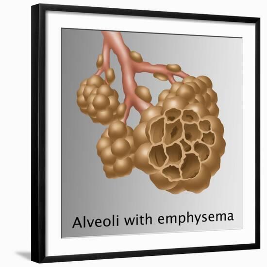 Alveoli with Emphysema-Gwen Shockey-Framed Giclee Print
