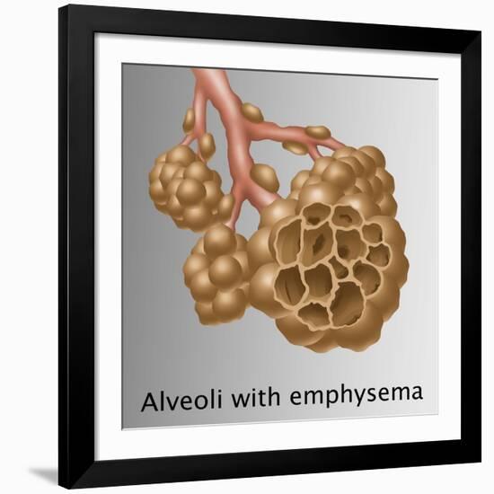 Alveoli with Emphysema-Gwen Shockey-Framed Giclee Print