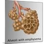 Alveoli with Emphysema-Gwen Shockey-Mounted Giclee Print