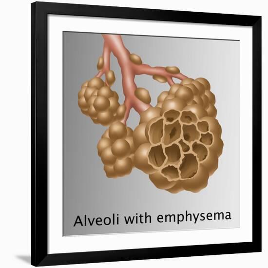 Alveoli with Emphysema-Gwen Shockey-Framed Giclee Print