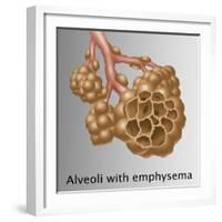 Alveoli with Emphysema-Gwen Shockey-Framed Giclee Print