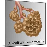 Alveoli with Emphysema-Gwen Shockey-Mounted Giclee Print