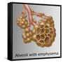 Alveoli with Emphysema-Gwen Shockey-Framed Stretched Canvas