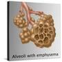 Alveoli with Emphysema-Gwen Shockey-Stretched Canvas