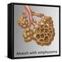 Alveoli with Emphysema-Gwen Shockey-Framed Stretched Canvas