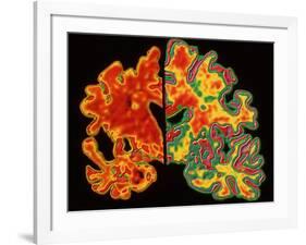 Alzheimer's Brain-PASIEKA-Framed Photographic Print