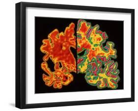 Alzheimer's Brain-PASIEKA-Framed Photographic Print