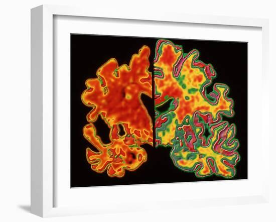 Alzheimer's Brain-PASIEKA-Framed Photographic Print