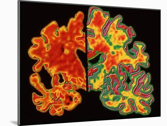Alzheimer's Brain-PASIEKA-Mounted Photographic Print