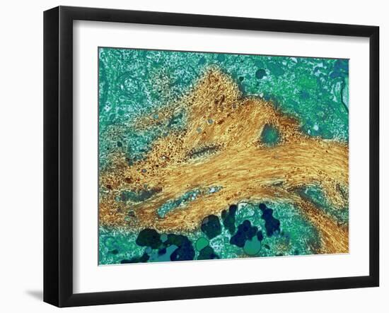 Alzheimer's Disease Brain Cell, TEM-Thomas Deerinck-Framed Photographic Print