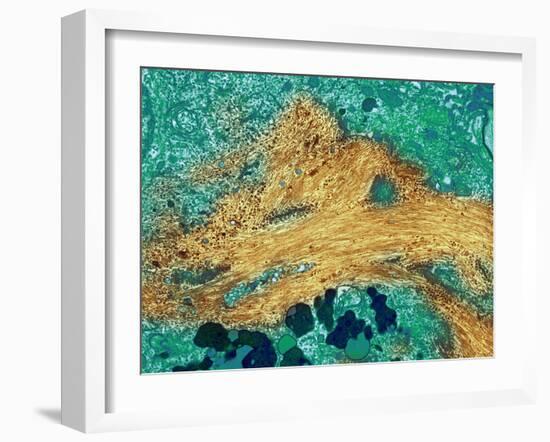 Alzheimer's Disease Brain Cell, TEM-Thomas Deerinck-Framed Photographic Print