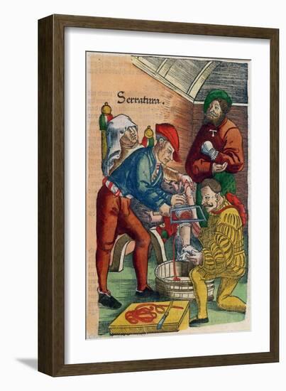 Amputation, Illustration from Feldtbuch Der Wundartzney by Hans Von Gersdorff, c.1540-Hans Or Johannes Ulrich Wechtlin-Framed Giclee Print