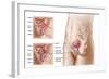 Anatomy of Bladder Suspension Procedure for Urinary Incontinence-null-Framed Art Print