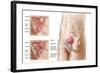 Anatomy of Bladder Suspension Procedure for Urinary Incontinence-null-Framed Art Print