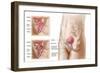 Anatomy of Bladder Suspension Procedure for Urinary Incontinence-null-Framed Art Print