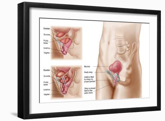 Anatomy of Bladder Suspension Procedure for Urinary Incontinence-null-Framed Art Print