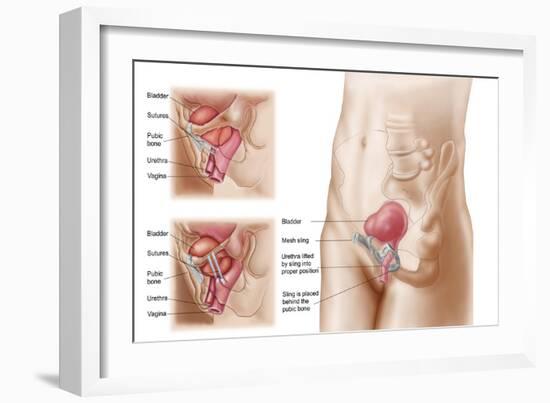 Anatomy of Bladder Suspension Procedure for Urinary Incontinence-null-Framed Art Print