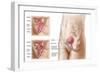 Anatomy of Bladder Suspension Procedure for Urinary Incontinence-null-Framed Art Print