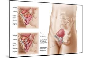 Anatomy of Bladder Suspension Procedure for Urinary Incontinence-null-Mounted Art Print