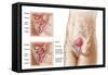 Anatomy of Bladder Suspension Procedure for Urinary Incontinence-null-Framed Stretched Canvas