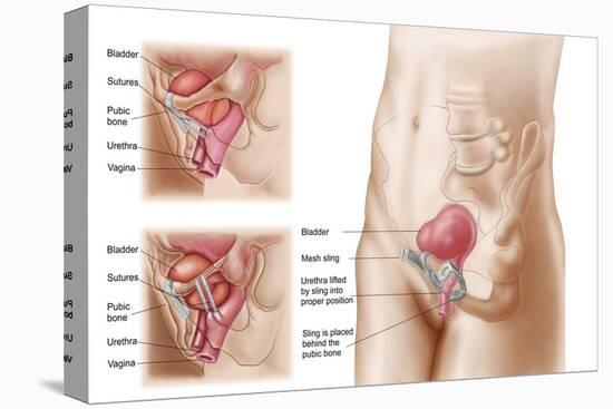 Anatomy of Bladder Suspension Procedure for Urinary Incontinence-null-Stretched Canvas