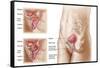 Anatomy of Bladder Suspension Procedure for Urinary Incontinence-null-Framed Stretched Canvas