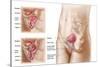 Anatomy of Bladder Suspension Procedure for Urinary Incontinence-null-Stretched Canvas