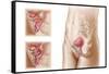 Anatomy of Bladder Suspension Procedure for Urinary Incontinence-null-Framed Stretched Canvas