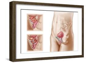 Anatomy of Bladder Suspension Procedure for Urinary Incontinence-null-Framed Art Print