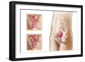 Anatomy of Bladder Suspension Procedure for Urinary Incontinence-null-Framed Art Print