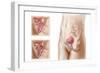 Anatomy of Bladder Suspension Procedure for Urinary Incontinence-null-Framed Art Print