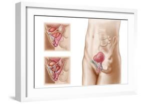 Anatomy of Bladder Suspension Procedure for Urinary Incontinence-null-Framed Art Print