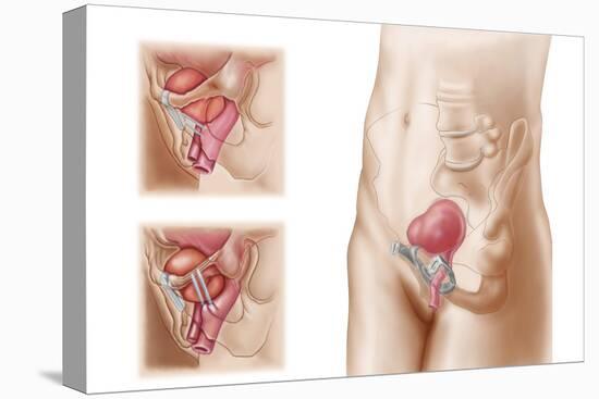 Anatomy of Bladder Suspension Procedure for Urinary Incontinence-null-Stretched Canvas