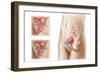 Anatomy of Bladder Suspension Procedure for Urinary Incontinence-null-Framed Premium Giclee Print