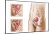 Anatomy of Bladder Suspension Procedure for Urinary Incontinence-null-Mounted Premium Giclee Print