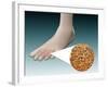 Anatomy of Foot Fungus with Microscopic Close-Up-null-Framed Art Print