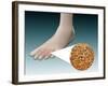 Anatomy of Foot Fungus with Microscopic Close-Up-null-Framed Art Print