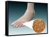 Anatomy of Foot Fungus with Microscopic Close-Up-null-Framed Stretched Canvas