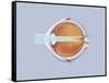 Anatomy of Human Eye Showing Focal Points-null-Framed Stretched Canvas