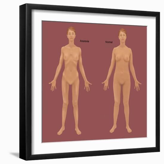 Anorexia Nervosa-Gwen Shockey-Framed Giclee Print