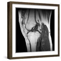 Anterior Cruciate Ligament Tear, CT Scan-Du Cane Medical-Framed Photographic Print