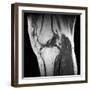 Anterior Cruciate Ligament Tear, CT Scan-Du Cane Medical-Framed Photographic Print