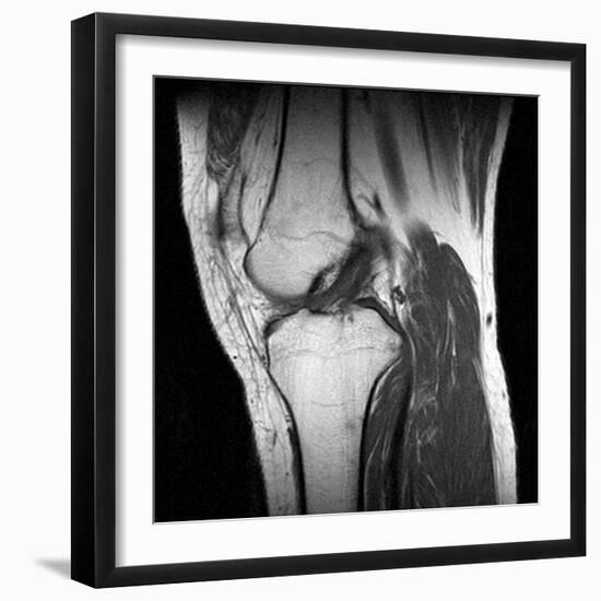 Anterior Cruciate Ligament Tear, CT Scan-Du Cane Medical-Framed Photographic Print