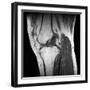 Anterior Cruciate Ligament Tear, CT Scan-Du Cane Medical-Framed Photographic Print