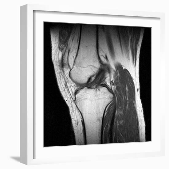 Anterior Cruciate Ligament Tear, CT Scan-Du Cane Medical-Framed Photographic Print