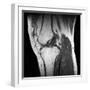 Anterior Cruciate Ligament Tear, CT Scan-Du Cane Medical-Framed Photographic Print