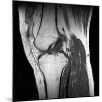 Anterior Cruciate Ligament Tear, CT Scan-Du Cane Medical-Mounted Photographic Print