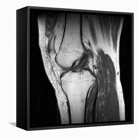 Anterior Cruciate Ligament Tear, CT Scan-Du Cane Medical-Framed Stretched Canvas