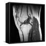 Anterior Cruciate Ligament Tear, CT Scan-Du Cane Medical-Framed Stretched Canvas